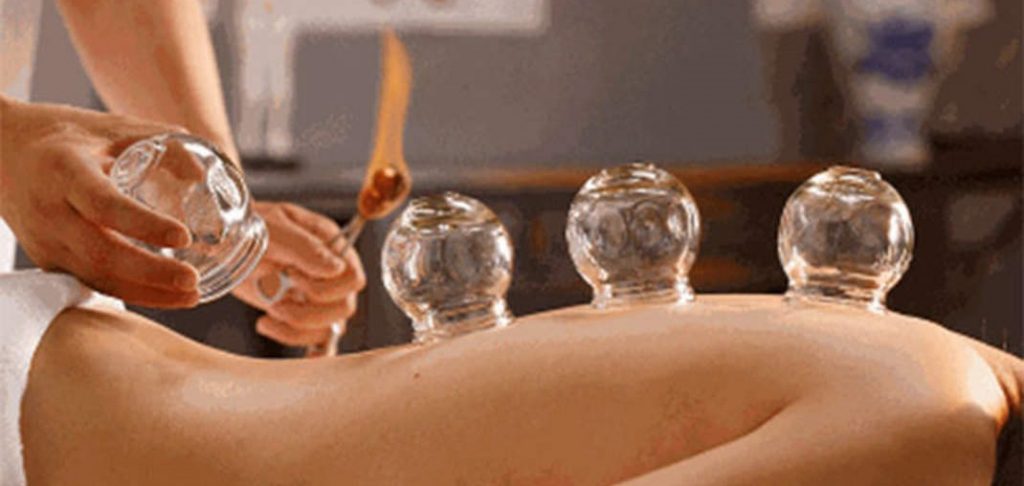 fire cupping