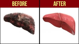 Importance of Liver Cleanse: 