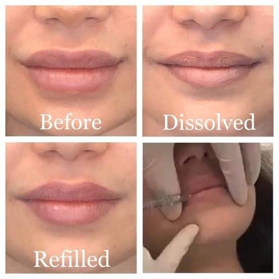 Botox & Dermal Fillers at Dr. Bali's Bliss