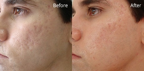 Acne Clean Up