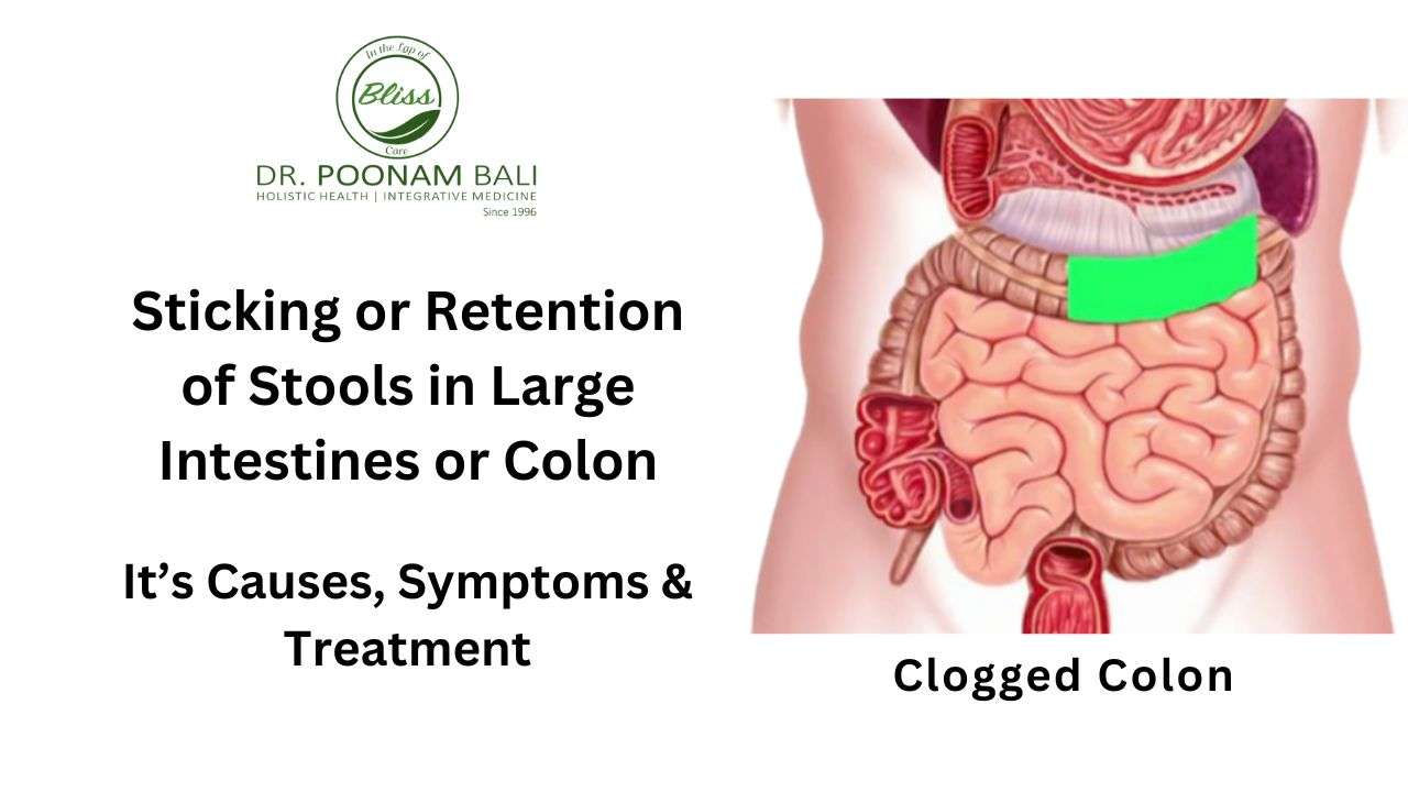 Sticking or Retention of Stools in Large Intestines or Colon