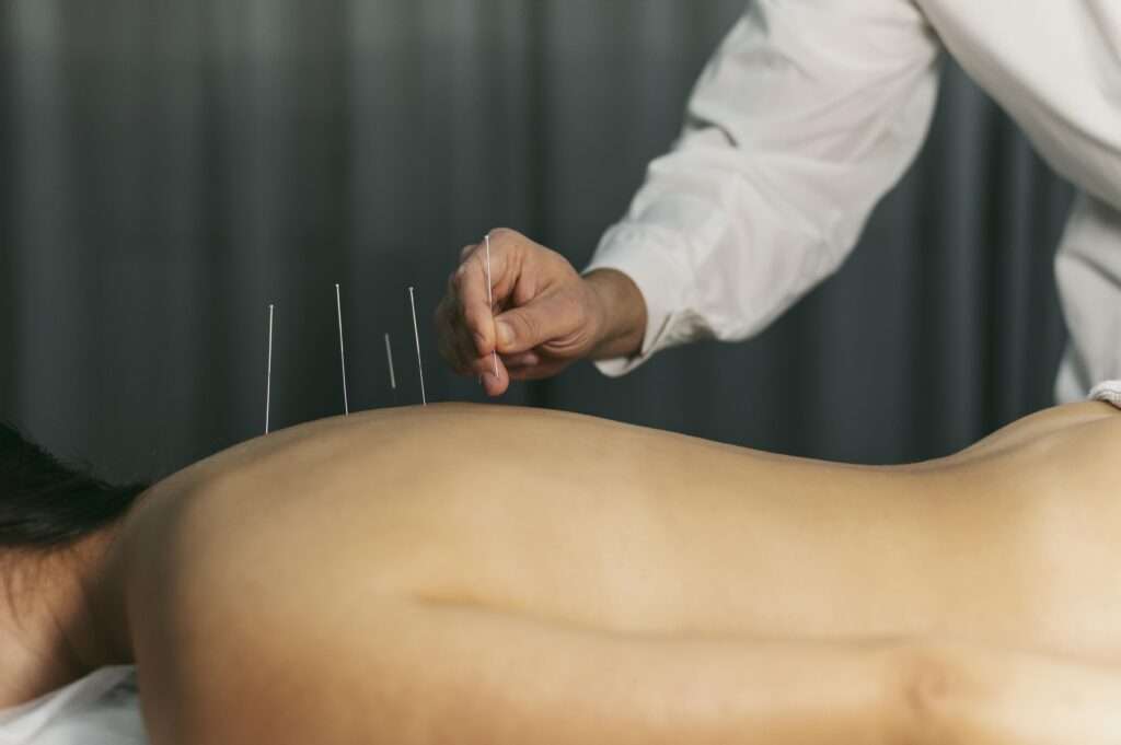 acupunture process