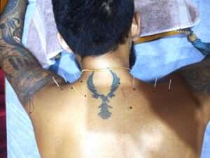 neck acupuncture