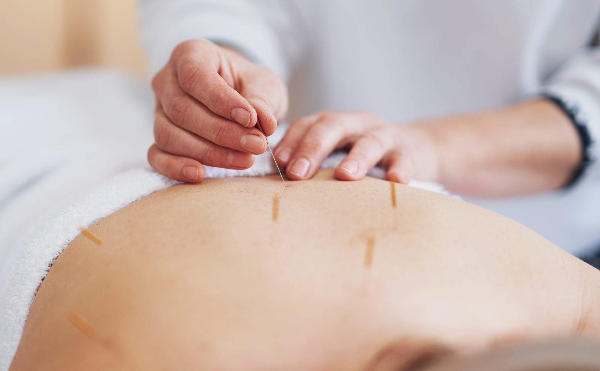 A acupuncture needle therapy in the studio A acupuncture needle therapy in the studio