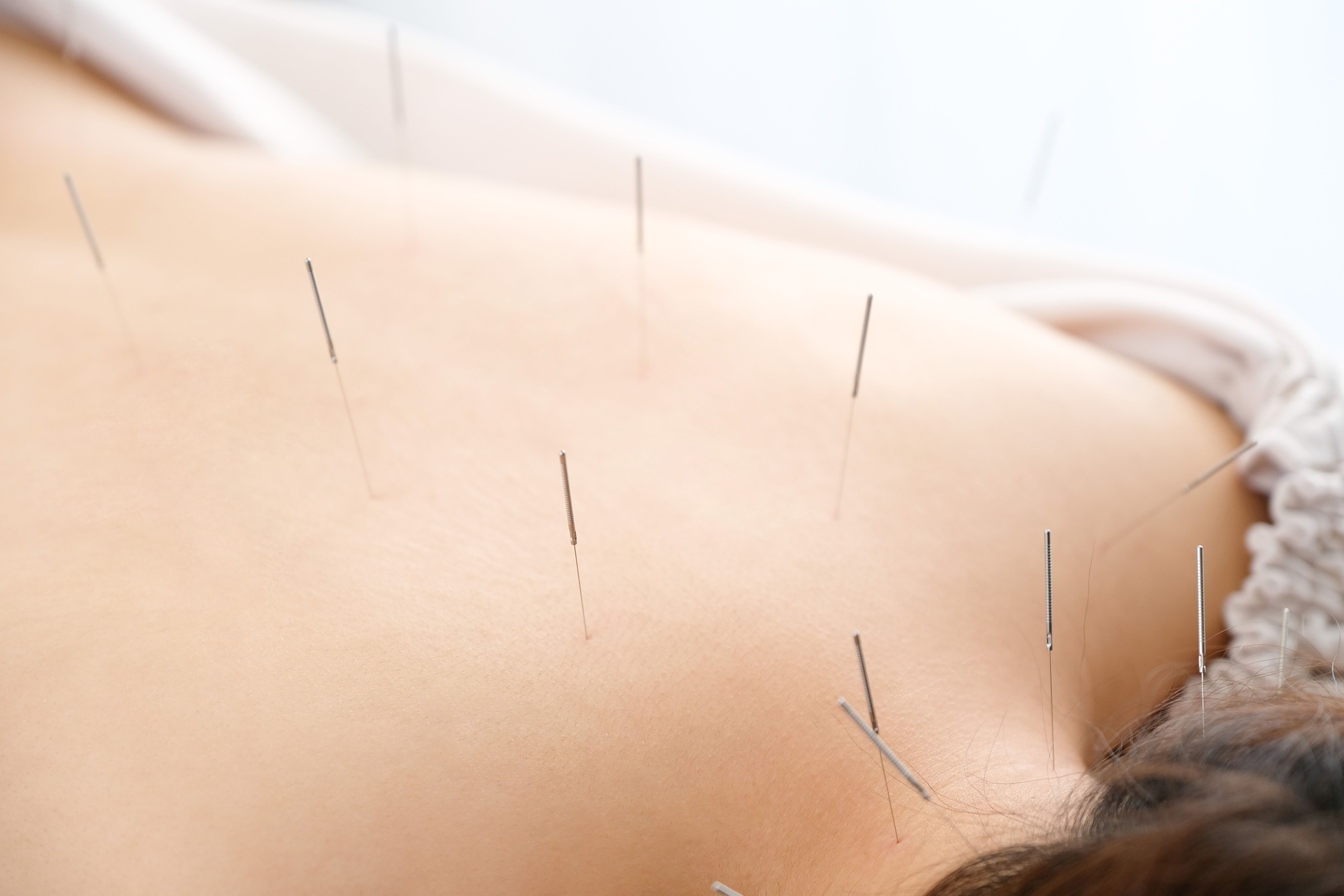 A woman with a needle stuck to her back at a bright acupuncture clinic A woman with a needle stuck to her back at a bright acupuncture clinic