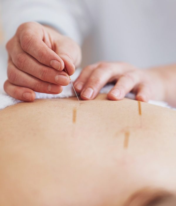 A acupuncture needle therapy in the studio