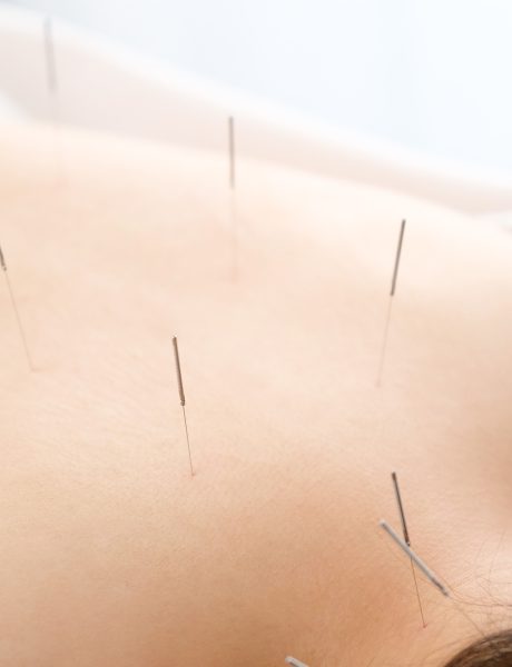 A woman with a needle stuck to her back at a bright acupuncture clinic